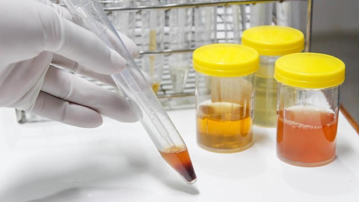Warna Urine Ini Jadi Tanda Sakit Ginjal, Secepatnya Periksa Bila Mengalaminya
