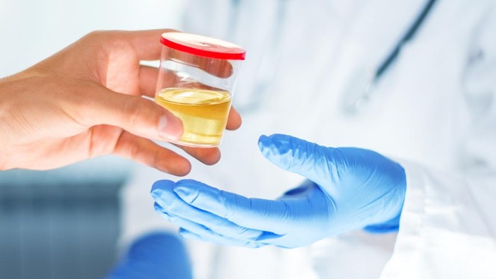 Sederet Warna Urine Dan Artinya, Dapat Jadi Tanda Penyakit Serius